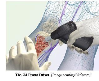 健康骨内通路心肺复苏静脉通道骨髓腔内注射系统标签:转载▼