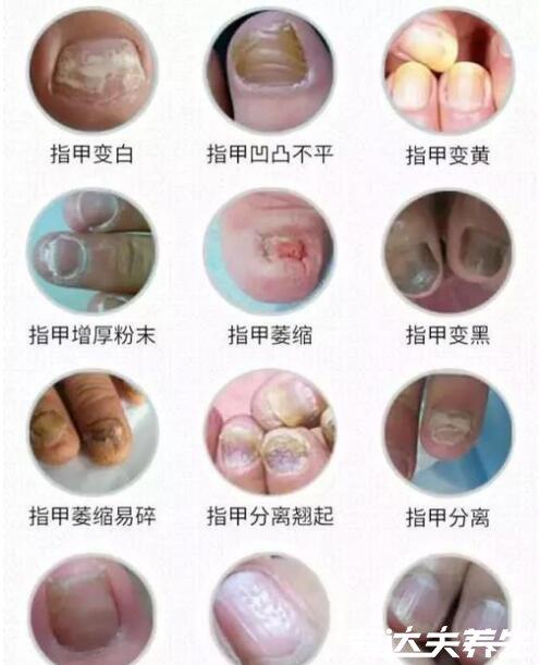 灰指甲初期症状图片及治疗方法有两大症状需及时治疗慎入