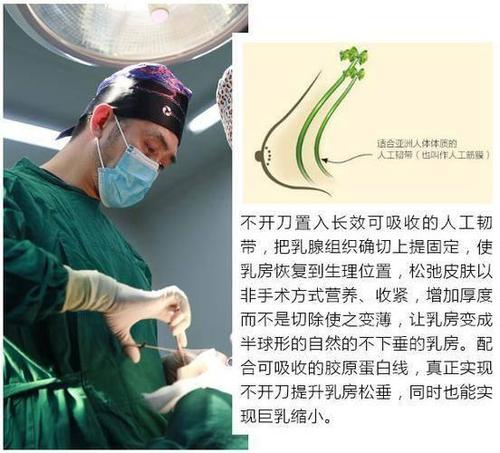 另一种是乳房塑形悬吊术,韩啸的不开刀人工韧带乳房上提术,是一种不