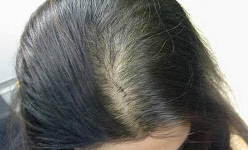 女性为什么会产后脱发?产后脱发怎么恢复