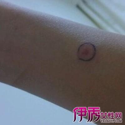 【图】结核皮试不正常图片大全 肺结核的症状以及治疗方法