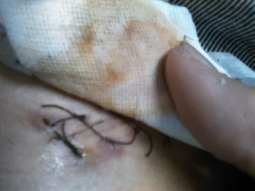 问:我阑尾炎手术后6天发现有点化脓了怎么办,严重