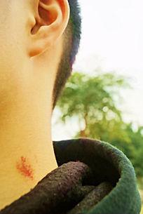 脖子上的草莓印