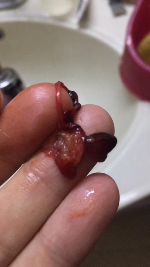 三个多月查处宫颈息肉很大有两个,今天收拾家突然掉出来的!这是