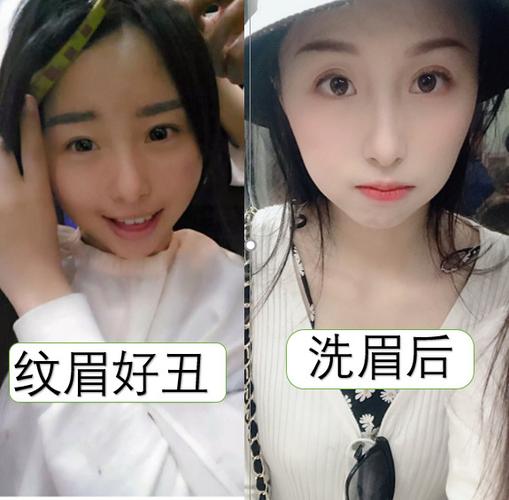 激光洗眉,终于让我摆脱了蜡笔小新同款眉毛