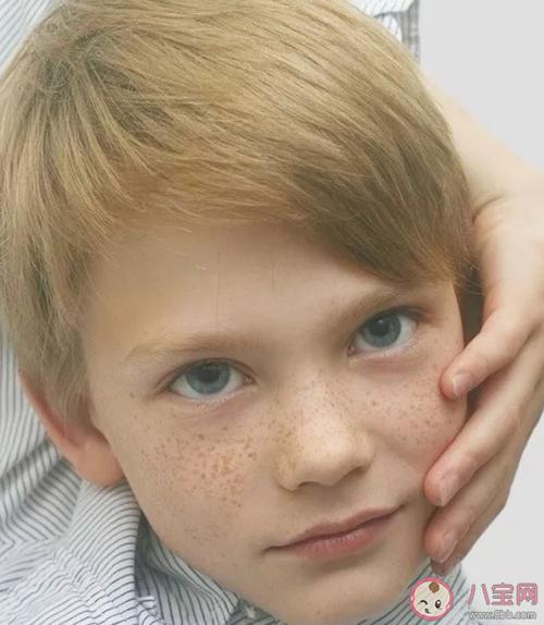 孩子长雀斑是什么原因孩子开始长雀斑怎么控制
