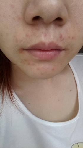 最近嘴巴周边长好多的小痘痘,是怎么回事?