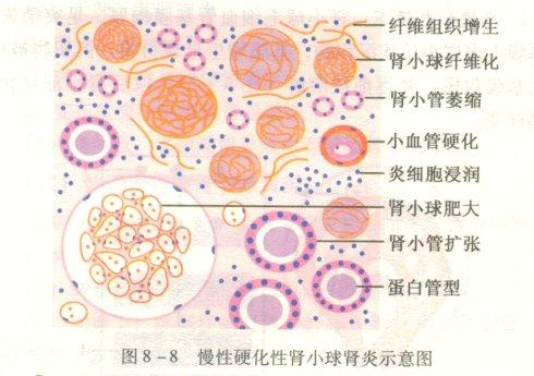 【资料】肾小球肾炎病理图解
