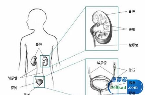 在家巧治肾结石的偏方:只需1味中药泡水喝