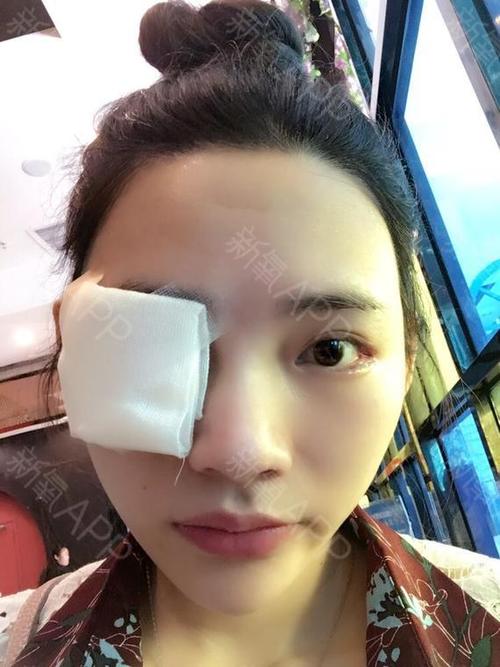 眼睛还是水肿得特别厉害,纱布也是一直包着的,除了滴