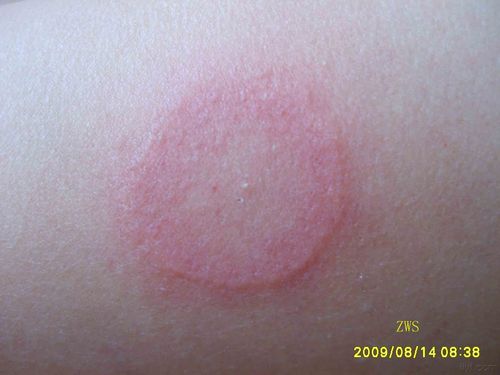 离心性环状红斑