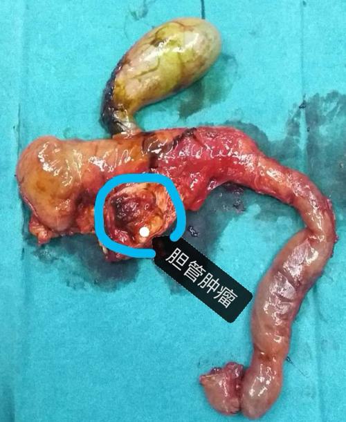 普外科年终力作——胰十二指肠切除术