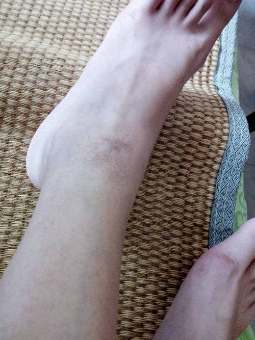 症状持续大概有两三个月了,就是脚踝附近起好多褐色斑点,摸上去不光