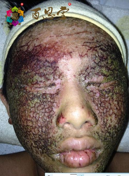 面部特应性皮炎怎么治疗方法有效?重症记录中