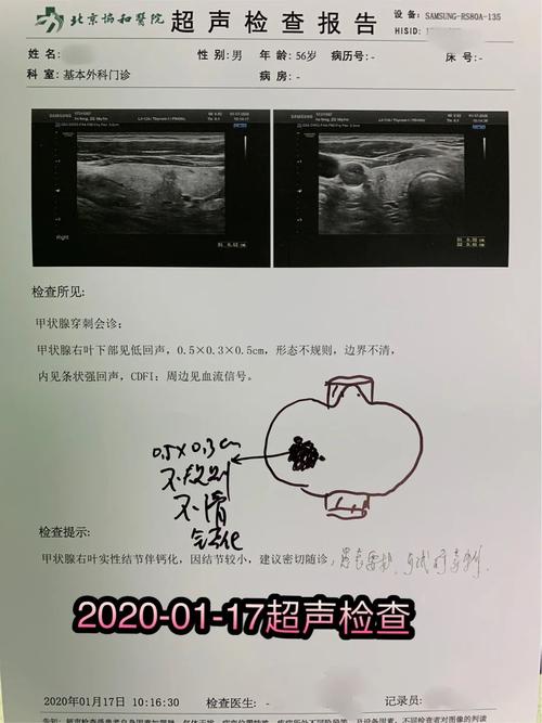 甲状腺超声检查提示结节恶性,下一步是观察,甲穿还是直接手术?