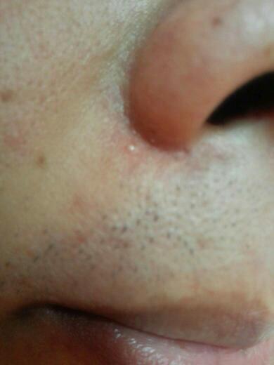 脸上这样一个小痘痘(里面有小白点)是叫什么?怎么引起