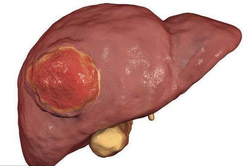 肝癌变会有5个信号,第一第二个很明显,肝不好的人要注意