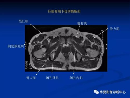 影像基础骨盆肌肉的mri解剖图