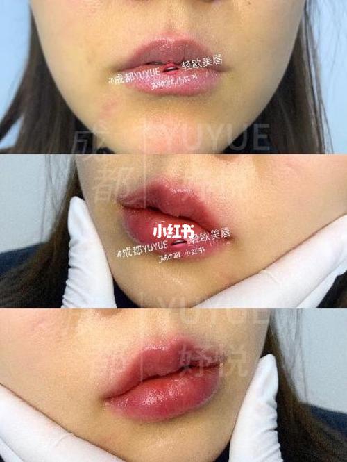 丰唇第二天实拍分享_丰唇_美妆_医美整形
