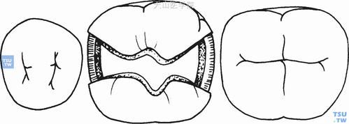 这一类洞也属于Ⅱ类洞.