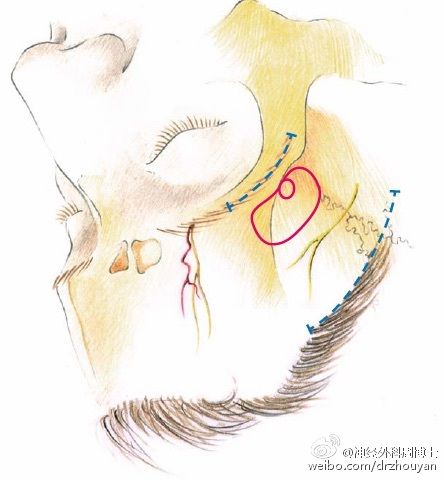 必须精确标记关键的解剖结构:眉间,额窦,眶上孔,颞线,额底,蝶骨小翼