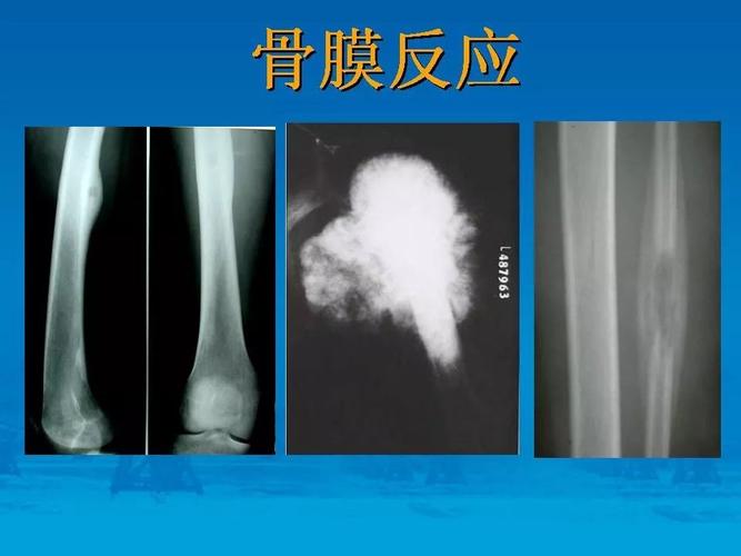 骨肿瘤良恶性鉴别诊断丨影像天地