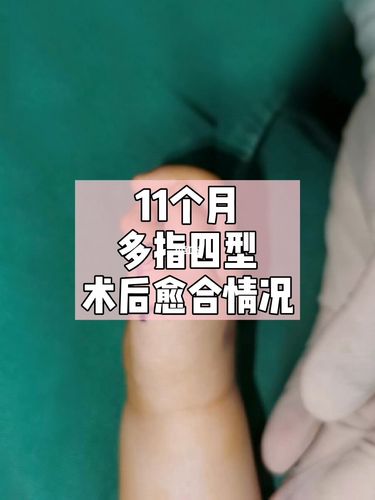 多指手术后多久可以恢复?_多指_美妆_医美整形