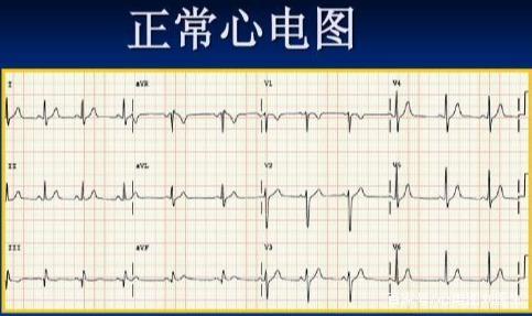 一份心电图是不是属于正常,重点看以下几点