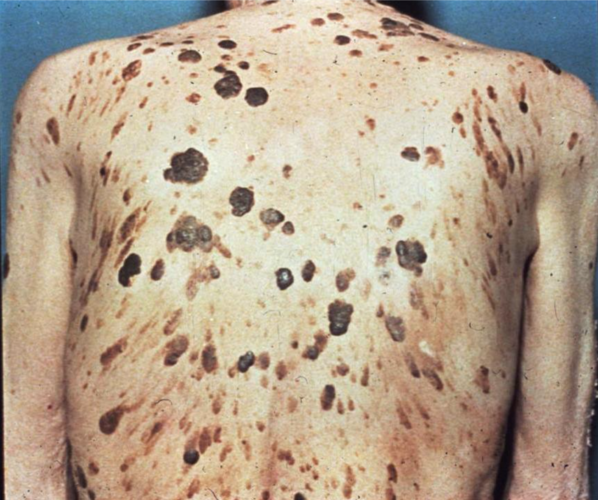 这些皮肤病需要警惕内脏肿瘤!皮肤上的癌症密码之二:泛发脂溢性角化症