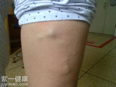 静脉曲张怎么治疗 请聆听专家为你讲解