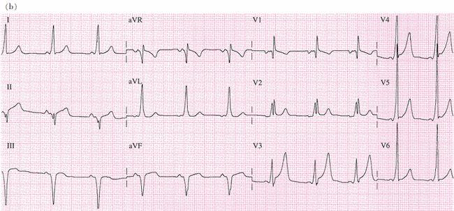 一文总结预激综合征的心电图特点和诊治预激综合征心电图医脉通