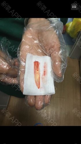 有没有懂的医生帮忙看看这是膨体还是硅胶,谢谢