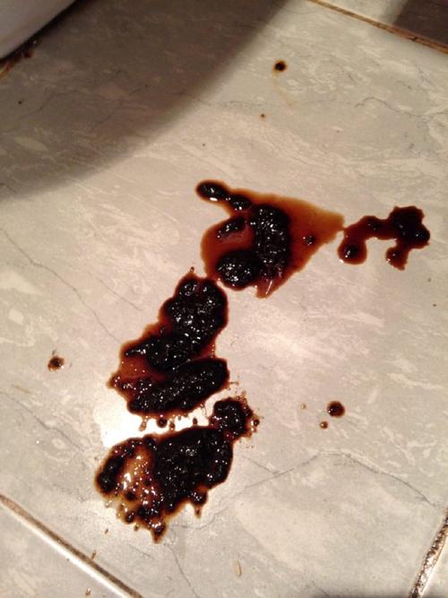 血便,粘稠,血水