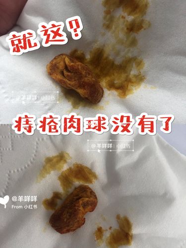 我竟然用了十五天消掉痔疮肉球92干货