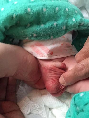 宝宝阴囊,大腿根部全红是什么皮肤病?用什么药?