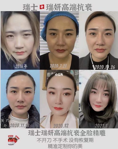 瑞士瑞妍筋膜再植提升效果,细胞美疗_瑞妍怎么样_保养