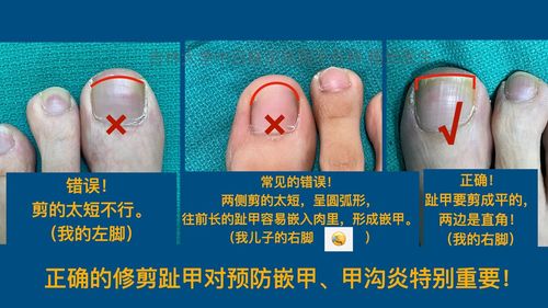 甲沟炎嵌甲的治疗