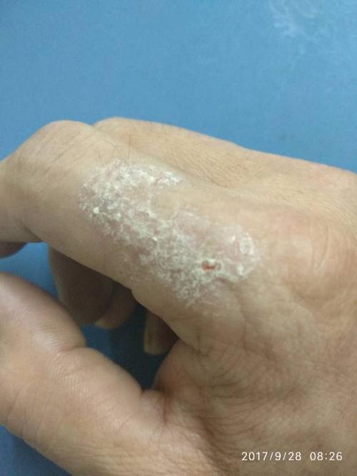 皮肤增厚,痒,搔后皮肤破裂,脱皮,用什么药?