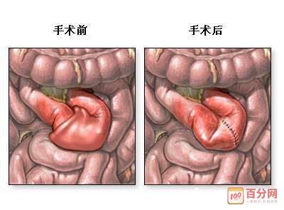 护士资格证外科护理:常见的几种肠梗阻及病人护理