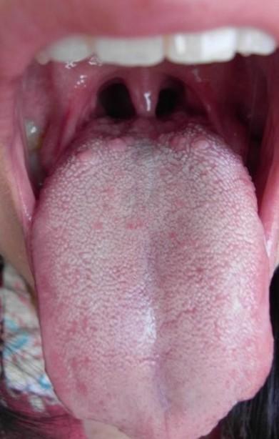 舌头里面,舌根处长了很多小疙瘩,是怎么回事?