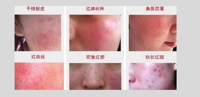 导致面部皮炎的原因有哪些?