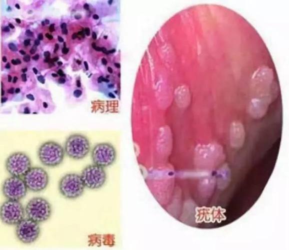 能用肉眼看出来的颗粒,我在某度一查,越来越怀疑自己感染了尖锐湿疣