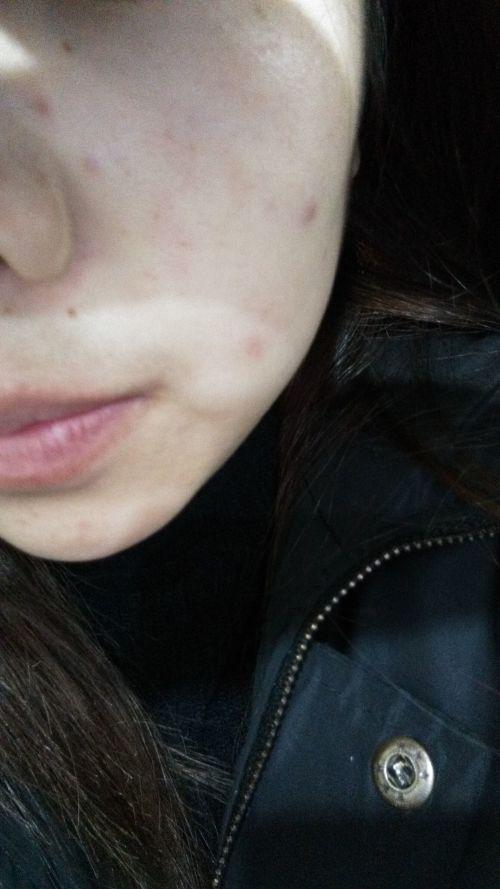 这个是什么痘痘啊谁知道谁知道 昨天凸起的 今天变平了