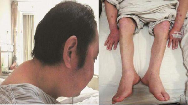 可见多处瘀斑,多血质外貌,满月脸(图16-1),水牛背(图16-2),满月脸,双