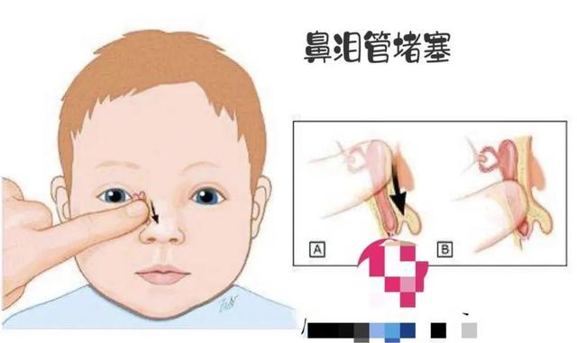 新手妈妈必须知道的鼻泪管堵塞!