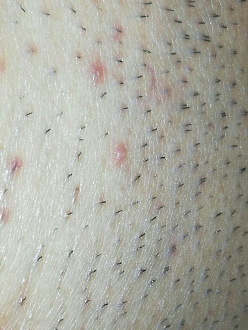 得了阴虱,毛剃了,用了几天药好像不见效啊!怎么办?