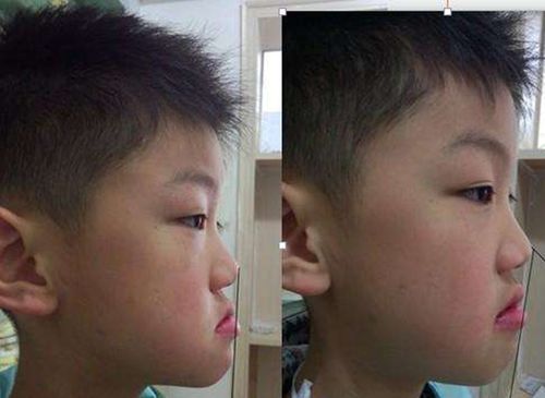 儿童牙齿地包天矫正的最佳年龄