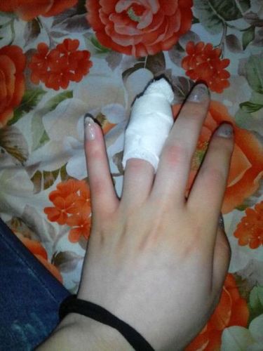 我想骗我男朋友手受伤了,有没有图片,不要太严重的