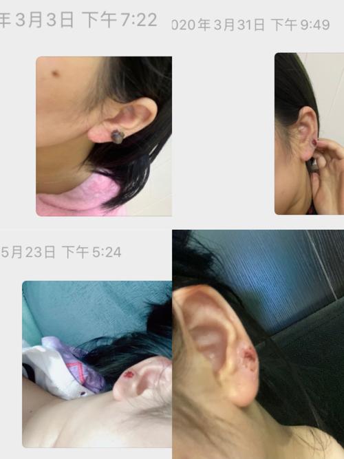 瘢痕疙瘩平了困扰了很久 现在露耳朵不怕了_耳洞_疤痕