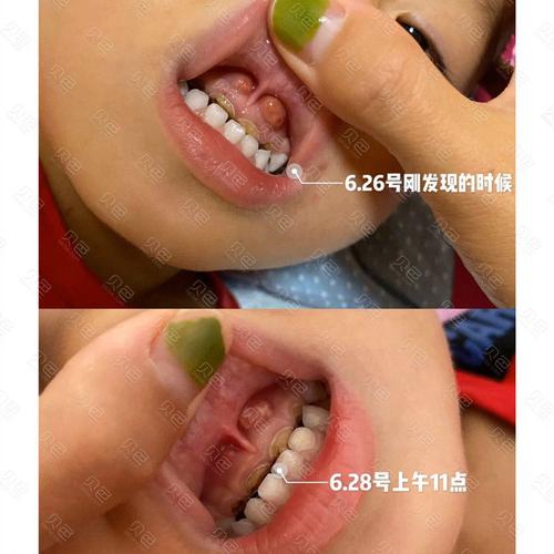 儿童门牙跟腱囊肿
